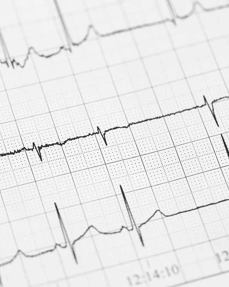 Electrocardiograma Electrocardiograma